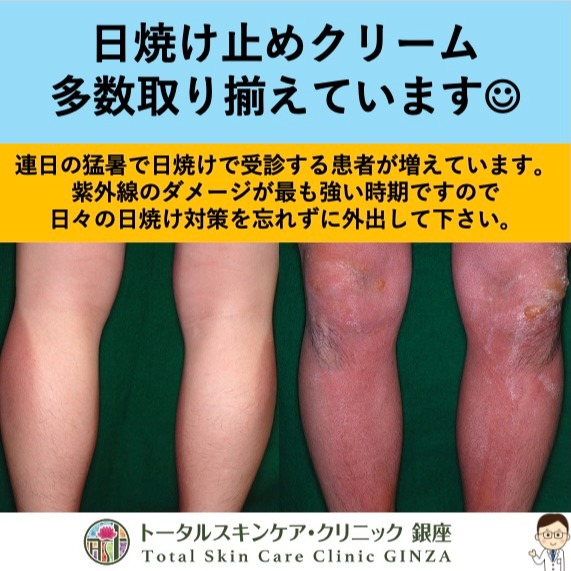 #1 日焼け止めクリーム
連日の猛暑で日焼けで受診する患者が増えています。紫外線のダメージが最も強い時期ですので日々の日焼け対策を忘れずに外出して下さい。
当院でも多数の日焼け止めクリームを取り揃えておりますので、自分に合った日焼け止めクリームを正しく選んで、正しい使い方でご使用下さい。
割引情報
ラロッシュポゼ製品は10%引きです!
院長
#東銀座 #築地 #皮膚科 #クリニック #聖路加 #聖路加国際病院 #日焼け止めクリーム #紫外線 #スキンケア
#銀座 #銀座松竹スクエア