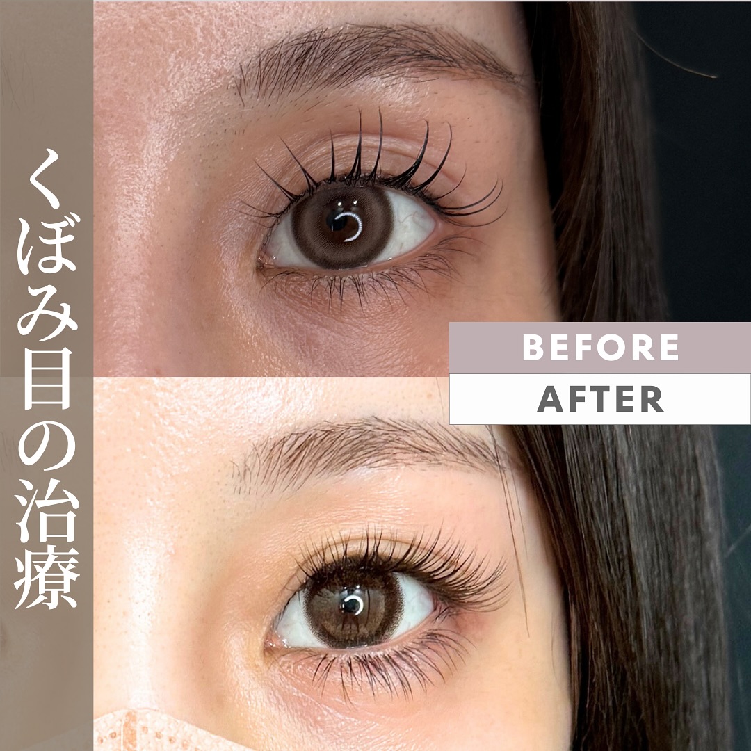 くぼみ目注射1回後。くぼみ目の原因と対策。
目の上がくぼみが出てしまう方が結構いらっしゃいます。
似合っている場合もありますが、年齢を感じさせることもあります。
近年のまつ毛美容液の成分が脂肪萎縮効果を発揮してしまうことで、眼窩脂肪が減っている方も見受けられます。
くぼみ目の原因はいくつかありますが、眼窩脂肪を始めとした眼窩容積の減少があることが多いです。
この場合、なんらかの形で少なくなっている容積を補います。
当院ではヒアルロン酸、脂肪注入、くぽみ目注射のいずれも可能ですが、くぼみ目注射が最も簡単で確実に変化をします。
眼瞼下垂とそれに伴う眉毛挙上がメインの場合は手術を行うことが有効です。
施術名: くぼみ目注射
リスク: 左右差、内出血、腫張などダウンタイム、疼痛、感覚障害、満足度の個人差、その他予期できないものなど。
金額:
くぼみ目注射 モニター価格 79,200円〜
#窪み目 #くぼみ目 #美容外科 #cosmeticsurgery #japan #tokyo #doubleeyelidsurgery #ptosis #ptosissurgery #shinyaogishima #荻島信也#azabuamourclinic #麻布十番 #六本木 #sunkeneyes #眼瞼下垂 #くぼみ目注射