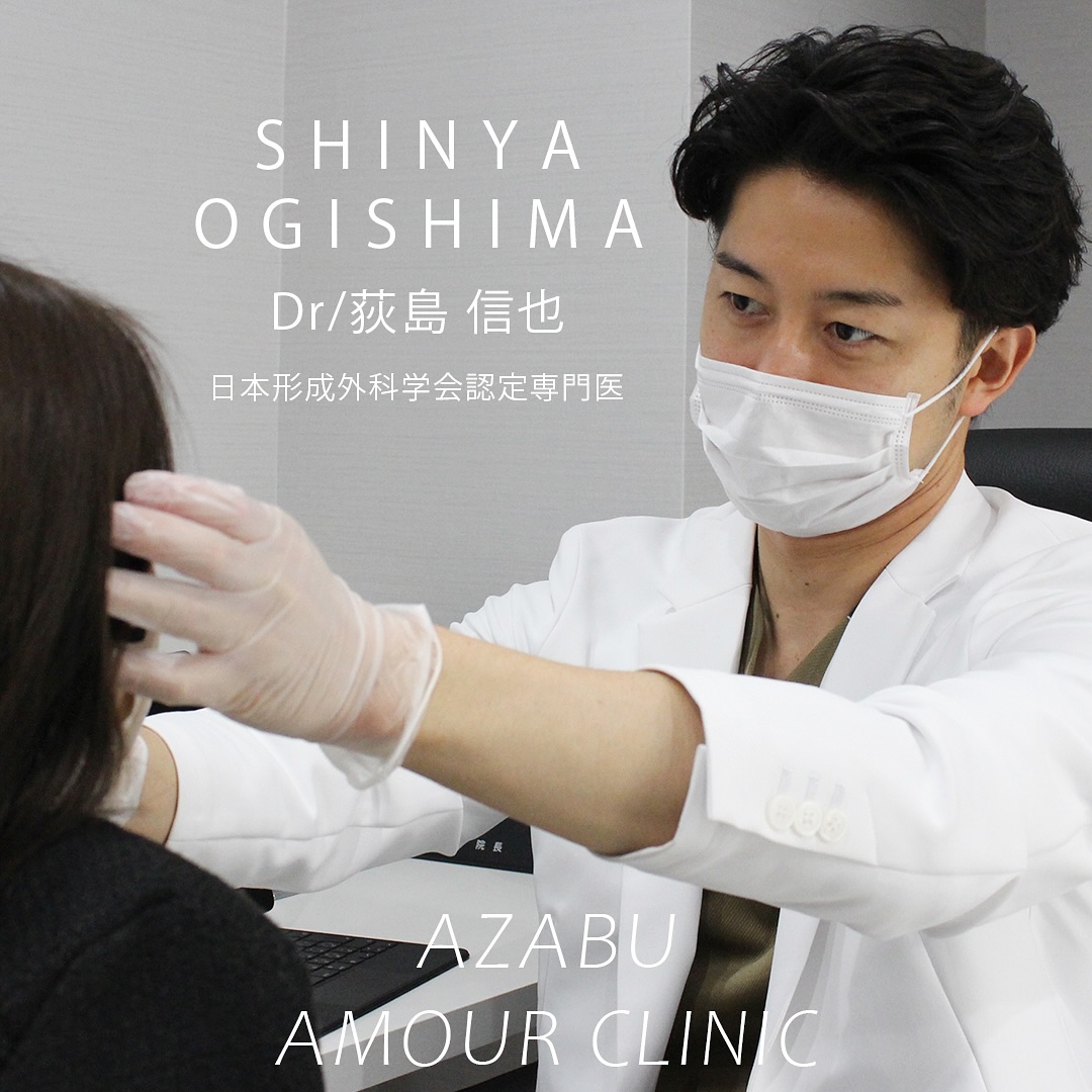 ヒアルロン酸による横顔、E Lineの整え
鼻手術、骨切り手術などにより横顔、E Lineの整えの希望が多いです。
ヒアルロン酸は溶けてしまうものであり、劇的な変化というところまではいかない事もありますが、ポイントを絞って適切に注入することで手術までは行かずとも、ある程度はっきりした変化を出すことが可能です。
ダウンタイムもほとんどないため、周りにバレずに少しずつ変化を出したい方に向いています。
デメリットがないわけではないですが、少ない治療です。
横顔の整えで重要なのが、額から鼻、口、顎のラインです。
ヒアルロン酸はいずれの部位にも手軽に変化が出せます。
額は丸みを帯びた形で、滑らかに。
鼻は鼻筋を通し、鼻先、鼻根部も適切に高くする。鼻根部を高くしすぎると不自然になる。
顎はE Lineを意識して前に出す。下方向に伸ばしすぎると顎が長く存在感が出てしまうため、必要以上に長くしない様にする。
いずれの場合も、リスクを考慮して安全な方法で入れることが重要です。
施術名: アラガン社製ヒアルロン酸注入 鼻、顎
ご料金: モニター価格 1ml 59,400円〜
リスク: 内出血、腫れ、疼痛、感覚障害、塞栓、感染、再注入、凹凸、アレルギーなど。
#鼻ヒアルロン酸
#顎ヒアルロン酸
#elineヒアルロン酸
#鼻顎ヒアルロン酸
#ヒアルロン酸
#filler
#injection
#hyarulonicacidinjection
#fillerinjectiontokyo
#cosmeticsurgery
#shinyaogishima
#麻布アムールクリニック
#azabuamourclinic
#荻島信也