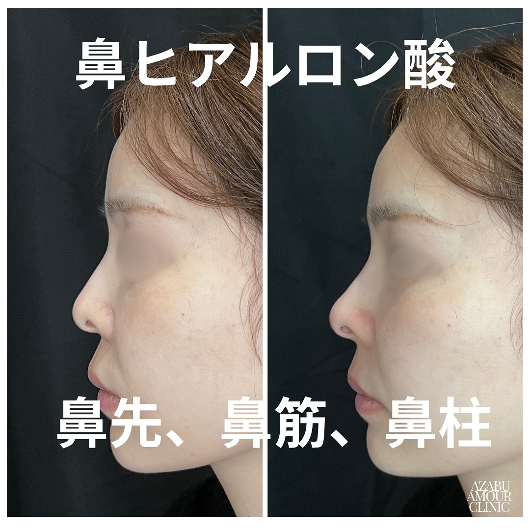 ヒアルロン酸による横顔、E Lineの整え
鼻手術、骨切り手術などにより横顔、E Lineの整えの希望が多いです。
ヒアルロン酸は溶けてしまうものであり、劇的な変化というところまではいかない事もありますが、ポイントを絞って適切に注入することで手術までは行かずとも、ある程度はっきりした変化を出すことが可能です。
ダウンタイムもほとんどないため、周りにバレずに少しずつ変化を出したい方に向いています。
デメリットがないわけではないですが、少ない治療です。
横顔の整えで重要なのが、額から鼻、口、顎のラインです。
ヒアルロン酸はいずれの部位にも手軽に変化が出せます。
額は丸みを帯びた形で、滑らかに。
鼻は鼻筋を通し、鼻先、鼻根部も適切に高くする。鼻根部を高くしすぎると不自然になる。
顎はE Lineを意識して前に出す。下方向に伸ばしすぎると顎が長く存在感が出てしまうため、必要以上に長くしない様にする。
いずれの場合も、リスクを考慮して安全な方法で入れることが重要です。
施術名: アラガン社製ヒアルロン酸注入 鼻、顎
ご料金: モニター価格 1ml 59,400円〜
リスク: 内出血、腫れ、疼痛、感覚障害、塞栓、感染、再注入、凹凸、アレルギーなど。
#鼻ヒアルロン酸
#顎ヒアルロン酸
#elineヒアルロン酸
#鼻顎ヒアルロン酸
#ヒアルロン酸
#filler
#injection
#hyarulonicacidinjection
#fillerinjectiontokyo
#cosmeticsurgery
#shinyaogishima
#麻布アムールクリニック
#azabuamourclinic
#荻島信也