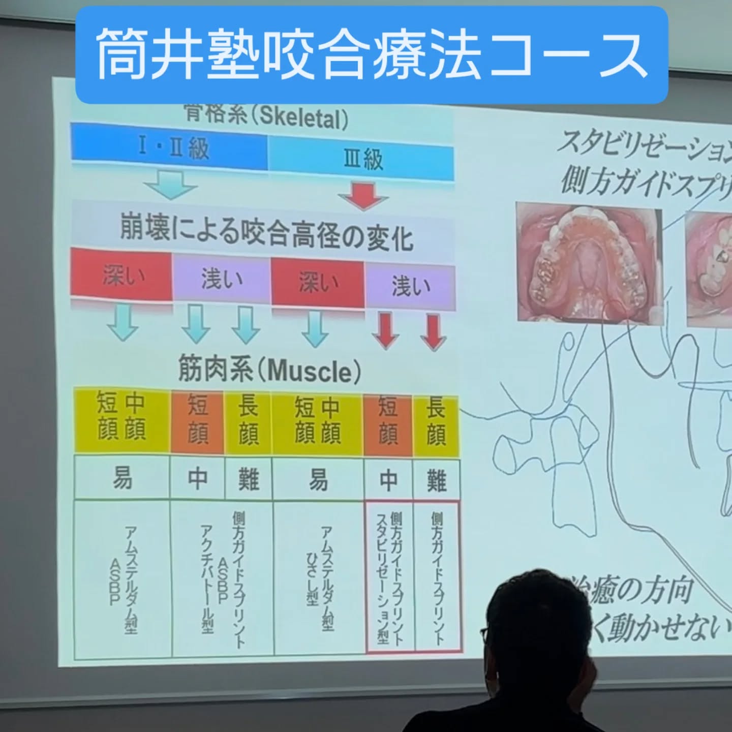 ◯筒井塾咬合療法ベーシックコース4日目
スプリント療法、Facescanデモンストレーション、包括歯科臨床の実践、長期症例についての講義でした。
受講生の先生方4ヶ月間御参加頂きありがとうございます。
来年度も東京で開催致しますのでご興味のある先生方の参加お待ちしております。
また、ご協力頂いた咬合療法研究会の先生方お忙しい中ありがとうございました。
筒井塾