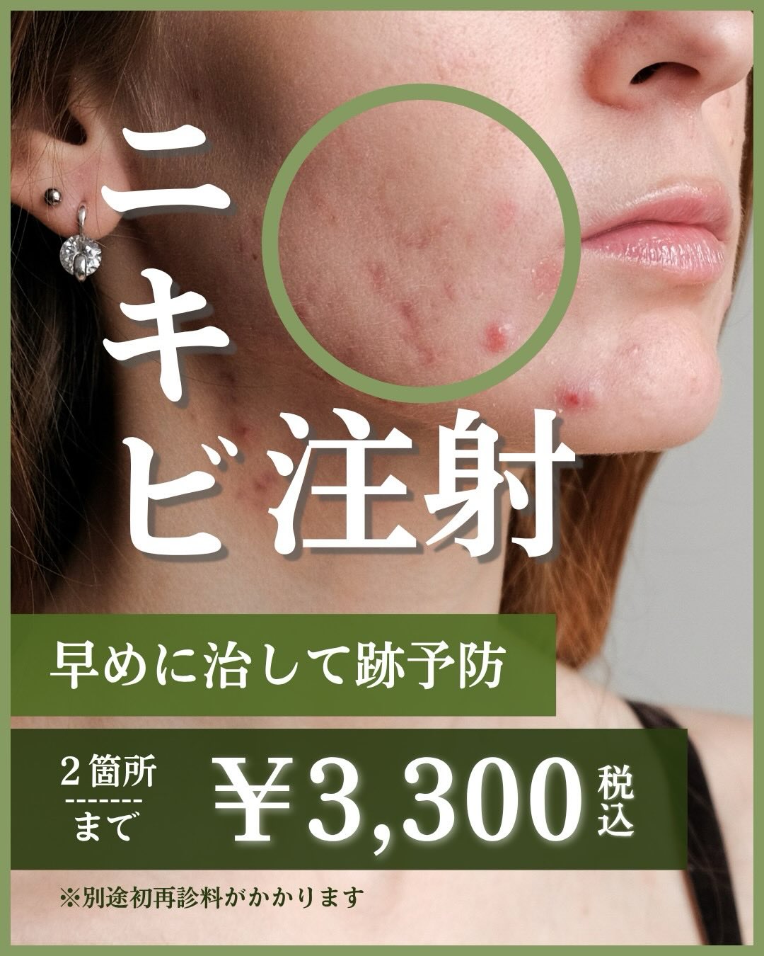 ・🪞
こんにちは
日本橋室町皮ふ科です🌷
本日はニキビ注射についてのご案内です💉
ニキビ注射とは…❔
赤く腫れて痛みを伴う炎症ニキビやしこりのようになったニキビに直接薬剤を注射して炎症を抑える治療です❤️🩹
☑︎赤く腫れて痛い
☑︎治りが悪い
☑︎早く炎症を抑えたい
そんな時におすすめの治療です💡
当院では自費の治療となり、
2個まで 料金3,300円
3個〜 1箇所につき プラス1,100円
となります✨
⚠️すべてのニキビに適応があるわけではなく、状態によっては医師の判断により他の治療をご提案することもあります
ぜひ一度ご相談ください👩⚕️
#日本橋室町皮ふ科 #ニキビ #ニキビ注射 #ニキビ治療 #皮膚科